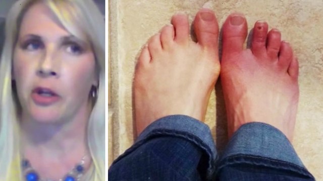 Erythromelalgie : elle souffre de douleurs au pied, les médecins diagnostiquent une infection. Mais c'était beaucoup plus grave