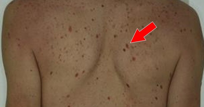 Voici tout ce qu'il faut savoir pour reconnaître un grain de beauté dangereux !