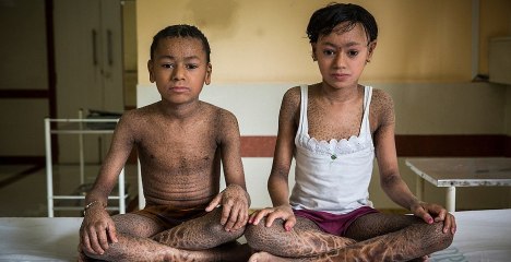 Lamellar Ichthyosis : quelle est donc cette mystérieuse maladie qui transforme la peau de ses victimes ?