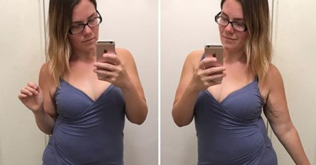 Bodyshaming nach Schönheits-OP