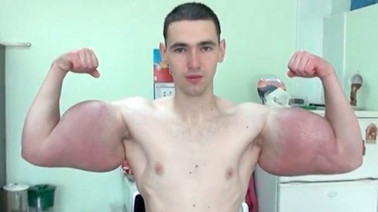 Russe spritzt sich Synthol in die Arme: Jetzt werden die Nebenwirkungen sichtbar