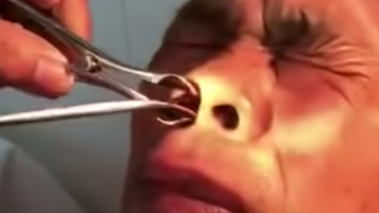 Mann klagt über Schmerzen: Dann zieht ihm der Arzt etwas Unglaubliches aus der Nase