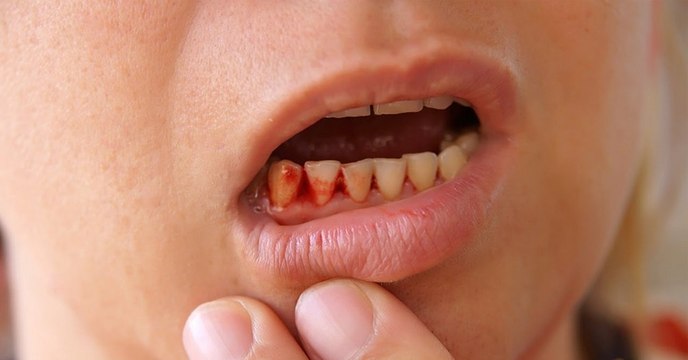 Tödliche Krankheit aus dem 18. Jahrhundert breitet sich in den Industrieländern wieder aus