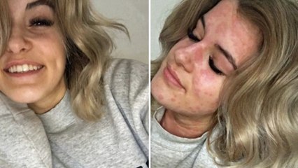 Kälteallergie: 21-Jährige muss wegen Kälte den Tod befürchten