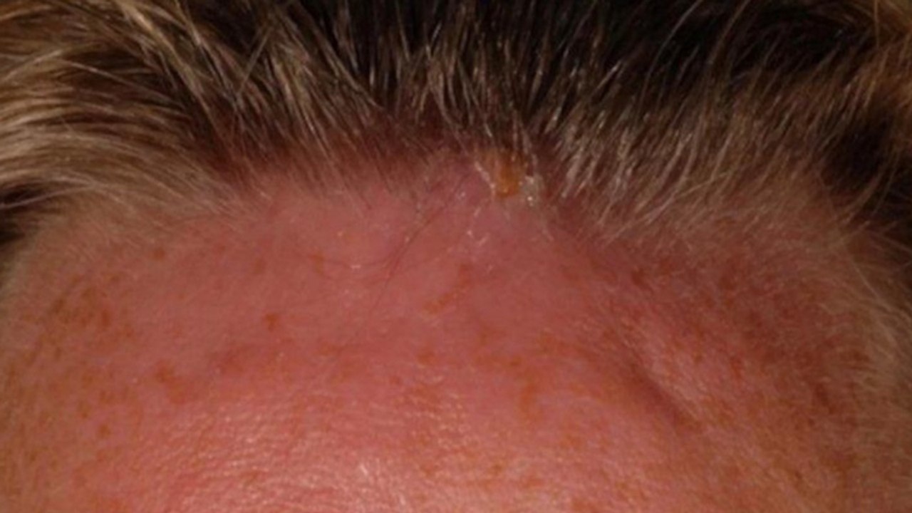 Nach Urlaub ein Loch im Kopf: Was die Ärzte herauslocken, ist echt heftig!