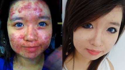 Cette fille souffre d'acné. Mais lorsqu'elle se maquille, le résultat est hallucinant