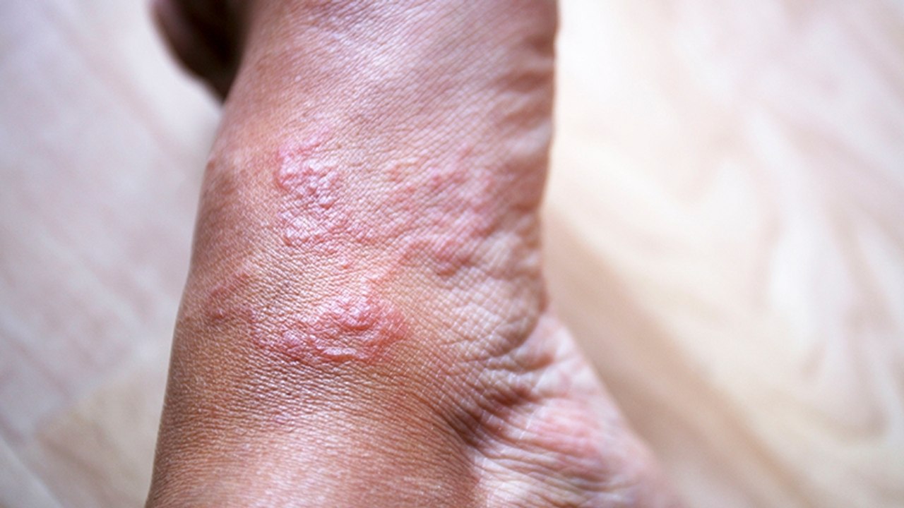 Drakunkulose: Eine beängstigende Krankheit, die nur durch einen Wurm verursacht wird