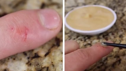 Une petite coupure, mais pas d'antiseptique ? Cette astuce est faite pour vous
