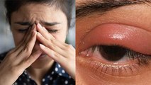 आंखों में सूखापन और सूजन Dry Eye Syndrome के Symptoms पता लगने पर तुरंत कराए जांच | Boldsky