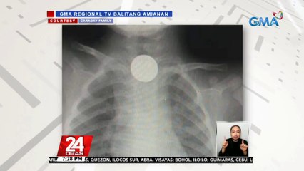2-anyos na batang lalaki, nabarahan ng pisong barya sa lalamunan | 24 Oras