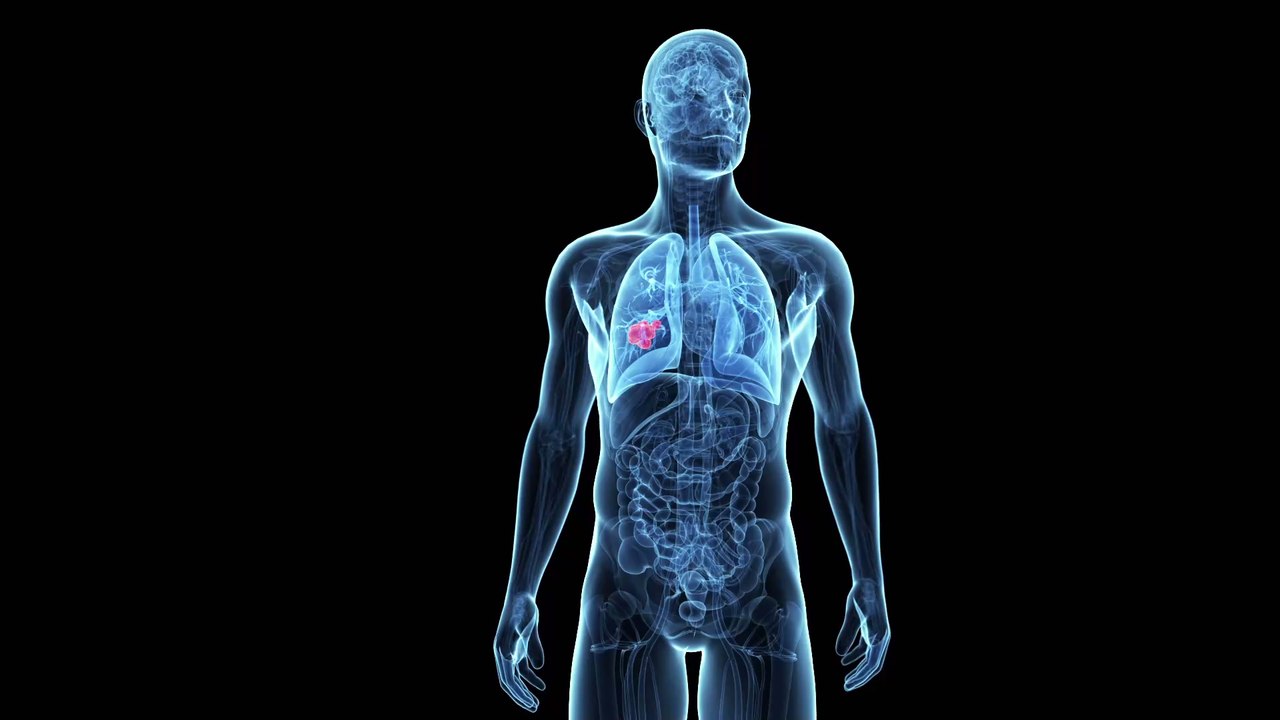 Lungenkrebs: Diese 8 Symptome sollte jeder kennen