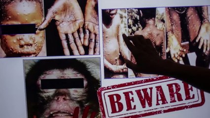 Zwei Fälle von Affenpocken in Großbritannien aufgetaucht