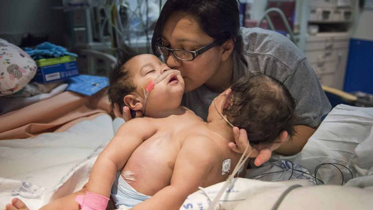 Ces siamoises étaient condamnées. Mais un médecin a changé leur destin