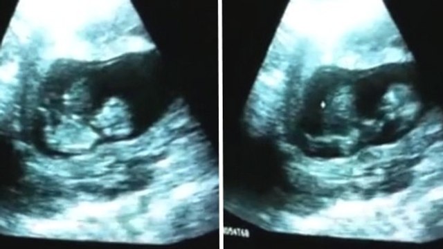 Ce bébé fait quelque chose de très drôle dans le ventre de sa maman !