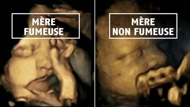 Des échographies révèlent ce qu'il se passe lorsqu'une femme fume pendant sa grossesse
