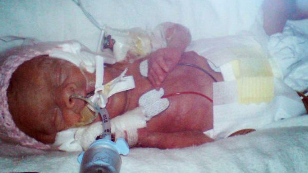 Ce bébé n'est né qu'à 5 mois de grossesse et s'est battu pour sa vie