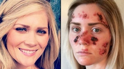 Défigurée par les cabines à UV, elle en dénonce les dangers en photos