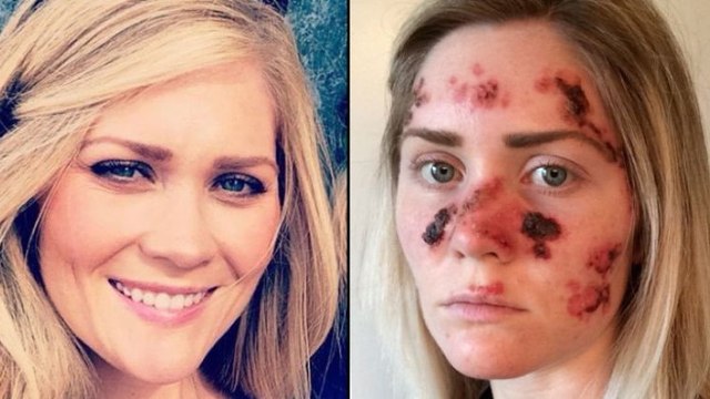 Défigurée par les cabines à UV, elle en dénonce les dangers en photos