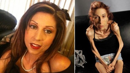 Anorexique depuis 10 ans, elle pèse aujourd'hui 18 kilos et appelle les internautes à l'aide