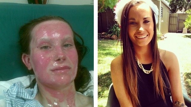 Gravement brûlée au visage, elle prend une magnifique revanche sur la vie