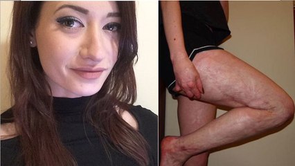 Gravement brûlée quand elle était bébé, elle décide aujourd'hui d'assumer son corps meurtri