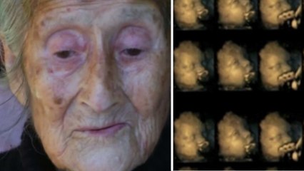 Âgée de 92 ans, cette femme apprend qu'elle porte un foetus mort depuis plus de 50 ans dans son abdomen