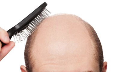 Haarverlust? So kann Einhorn-Lifting helfen