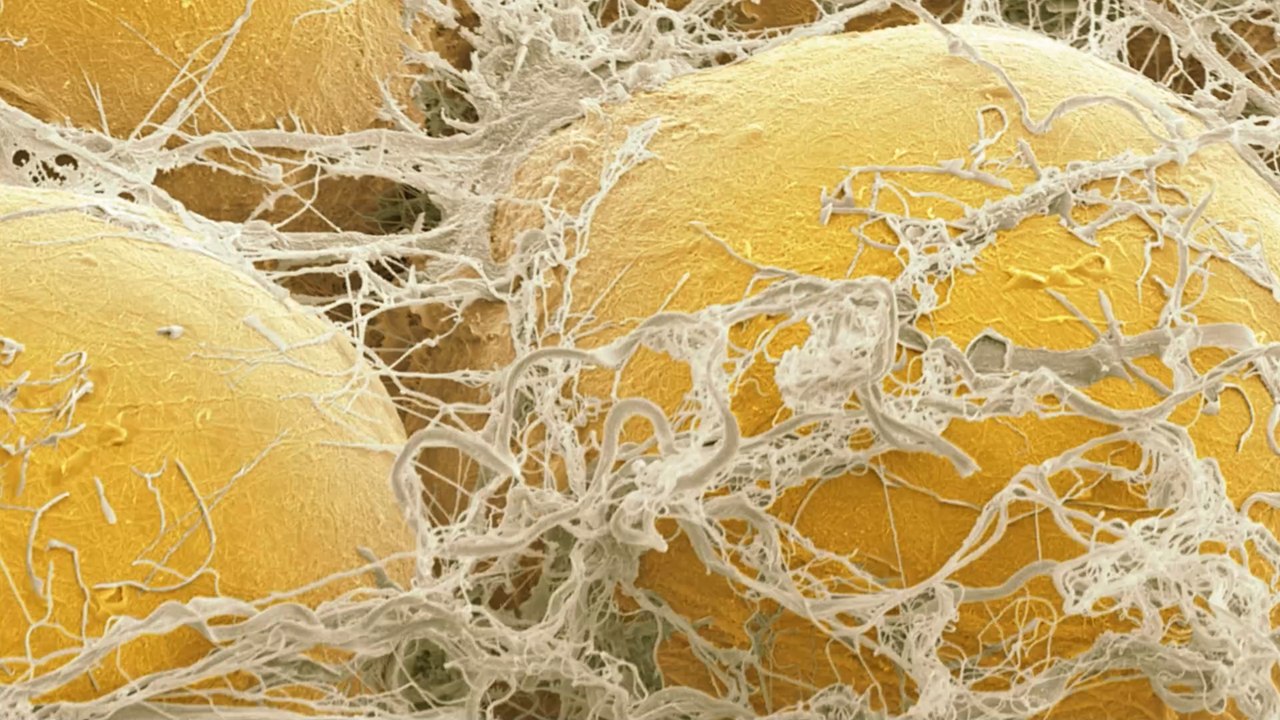 Neue Studie deckt auf, warum mehrgewichtige Menschen häufiger schwere Covid-Krankheitsverläufe haben