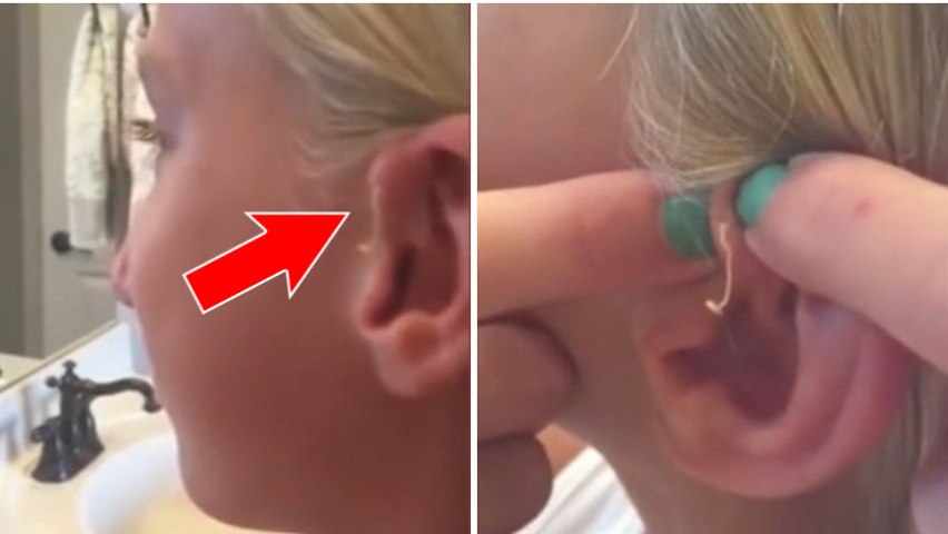 Elle se perce un bouton vieux de 6 ans sur l'oreille - Vidéo Dailymotion