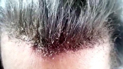Des centaines de poux grouillent sur la tête de cette femme