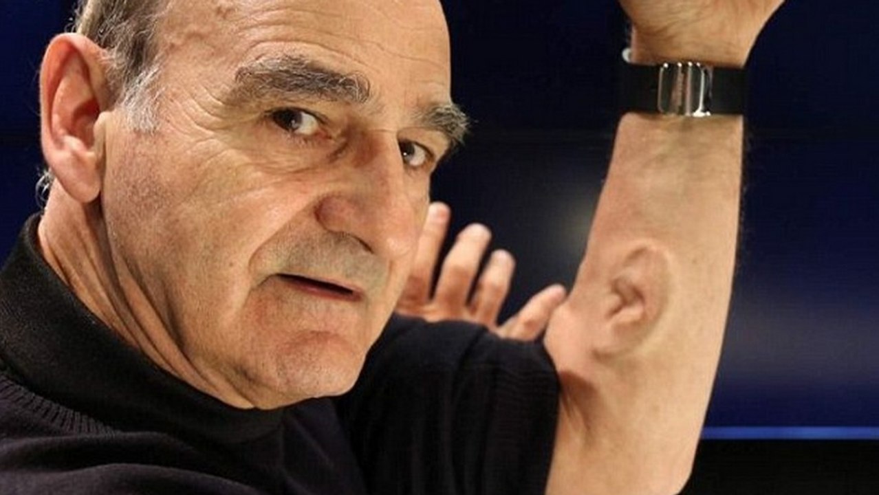 Cet homme s'est greffé une oreille dans le bras pour la relier à Internet