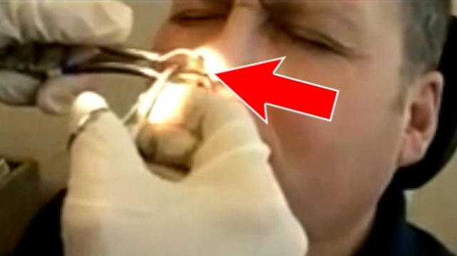 Il a des douleurs au nez, le médecin lui retire quelque chose d'incroyable