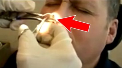 Il a des douleurs au nez, le médecin lui retire quelque chose d'incroyable
