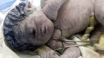 La naissance d'un bébé cyclope en Egypte bouleverse les internautes