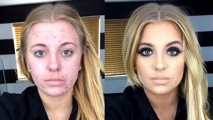 Moquée par les internautes à cause de son acné, cette blogueuse donne la meilleure des réponses