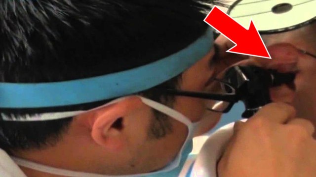Cette femme se plaignait de fortes douleurs à l'oreille, les médecins y découvrent un mille-pattes coincé à l'intérieur