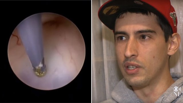 Etats-Unis : des médecins découvrent un ver solitaire dans son cerveau