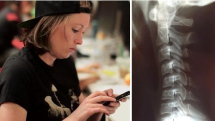 "Text Neck" : quand les téléphones portables créent de nouvelles maladies