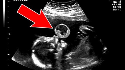 L'échographie de ce bébé 'faisant une bulle' cache une terrible réalité