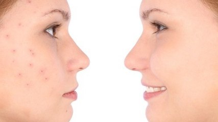 Découvrez 4 remèdes contre l'acné souvent ignorés