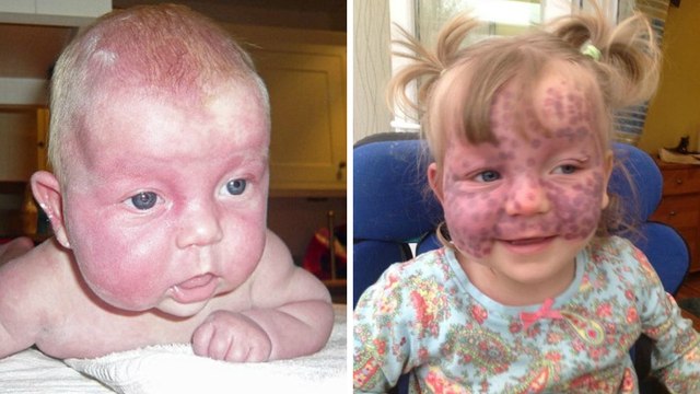 A 5 ans, cette fillette atteinte d'une maladie extrêmement rare émeut tout le web