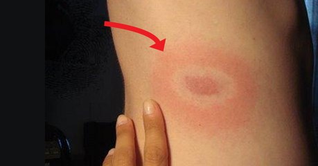 Les tiques attaquent, quels sont les bons gestes à avoir ?