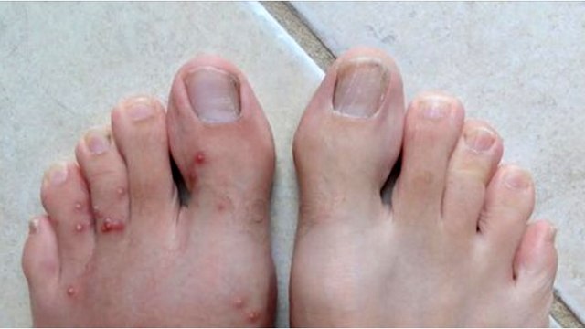 Comment identifier les piqûres d'insecte en été? Voici la réponse