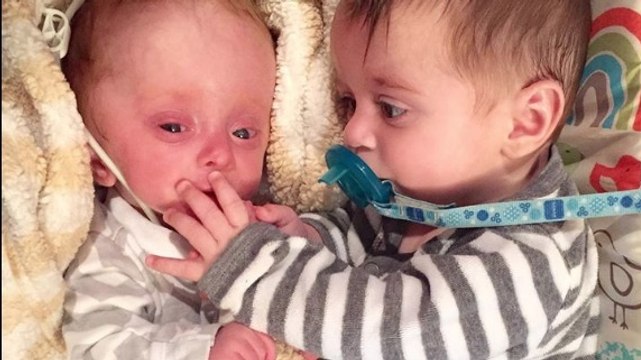 Né sans cerveau, ce bébé s'est fait abandonner par sa mère. Mais quand ce couple est arrivé...