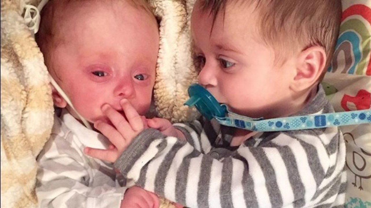 Né sans cerveau, ce bébé s'est fait abandonner par sa mère. Mais quand ce couple est arrivé...