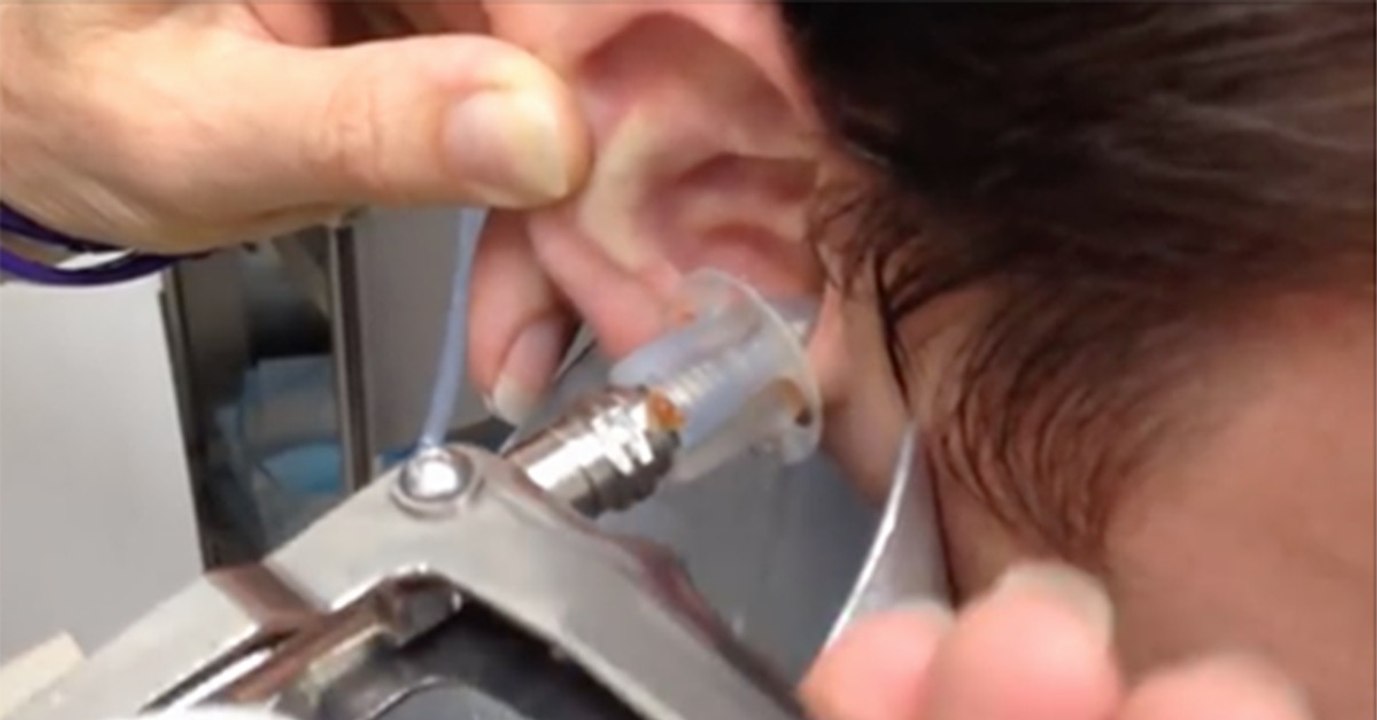 Un médecin injecte de l'eau dans l'oreille d'un patient. Ce qui en sort est inimaginable !