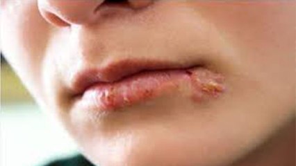 Lips पर दिखे ऐसे Symptoms तो हो जाएं सावधान वरना... | Boldsky