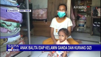 Balita Idap Kelamin Ganda dan Kurang Gizi, Orangtua Berharap Segera Dapat Penanganan Medis