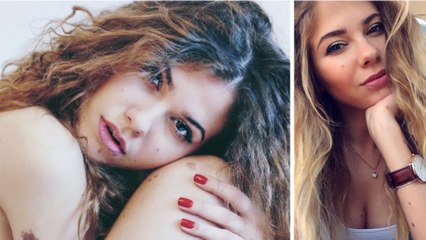 Yulianna Yussef : atteinte d'un naevus géant congénital, les médecins la disaient condamnée à sa naissance. Aujourd'hui, elle prend la plus belle des revanches