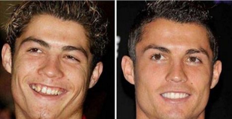Le secret le mieux gardé de Cristiano Ronaldo : Son addiction excessive au botox